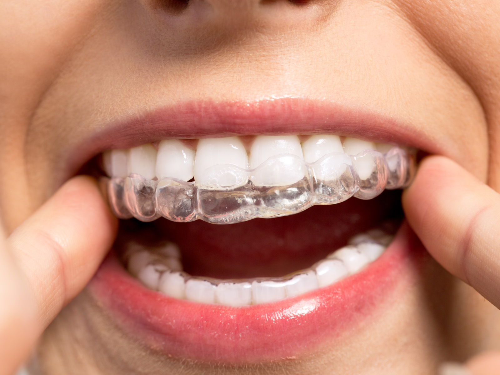Can Invisalign loosen teeth?