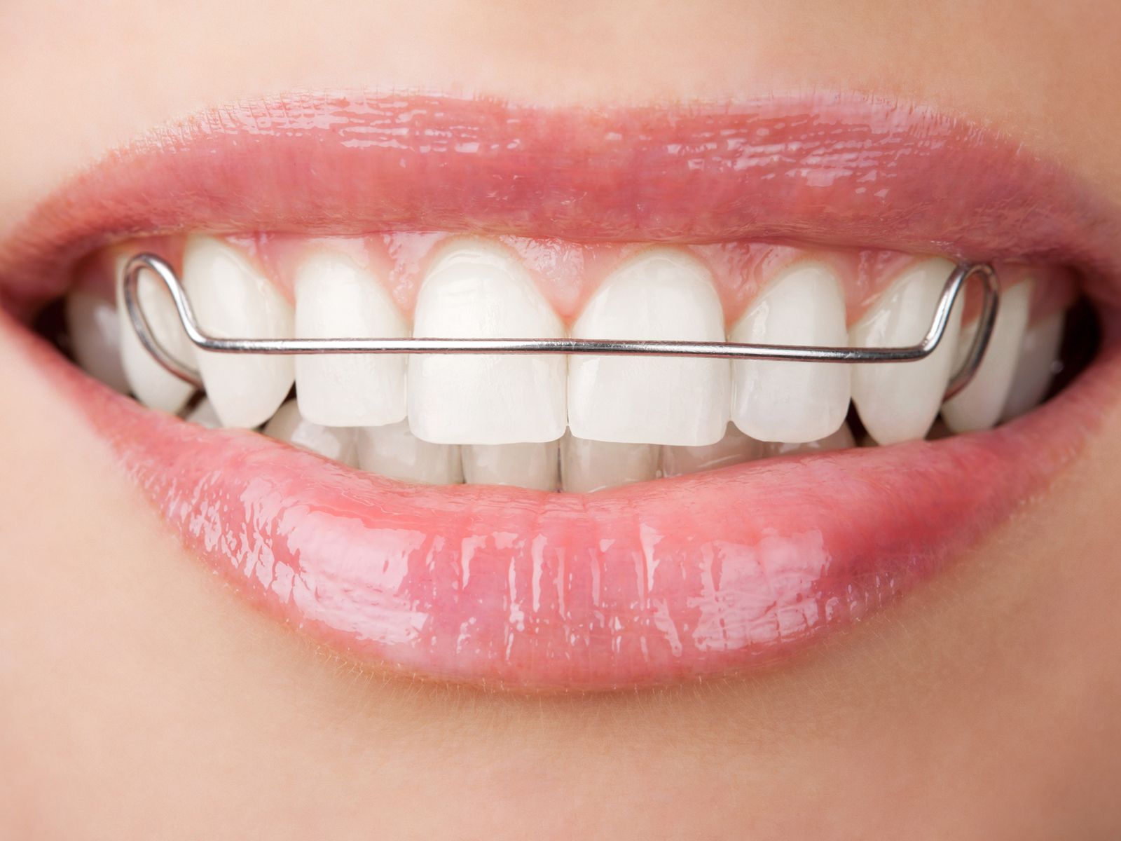 Are plastic or metal retainers better?