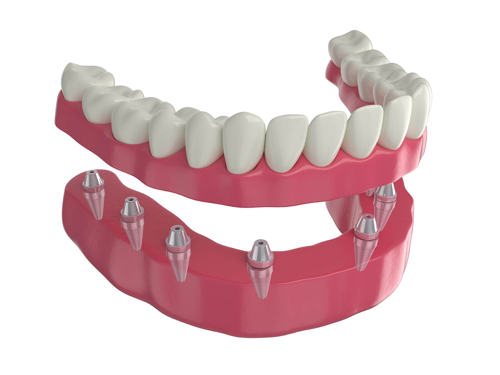 Removable Dentures With Implants & How They Work