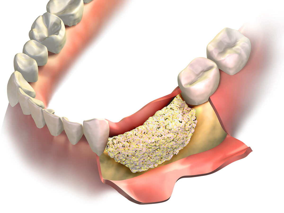 Dental Bone Graft Recovery & Aftercare