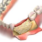 Dental Bone Graft Recovery & Aftercare