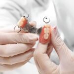 Understanding Dental Implant Overdentures?