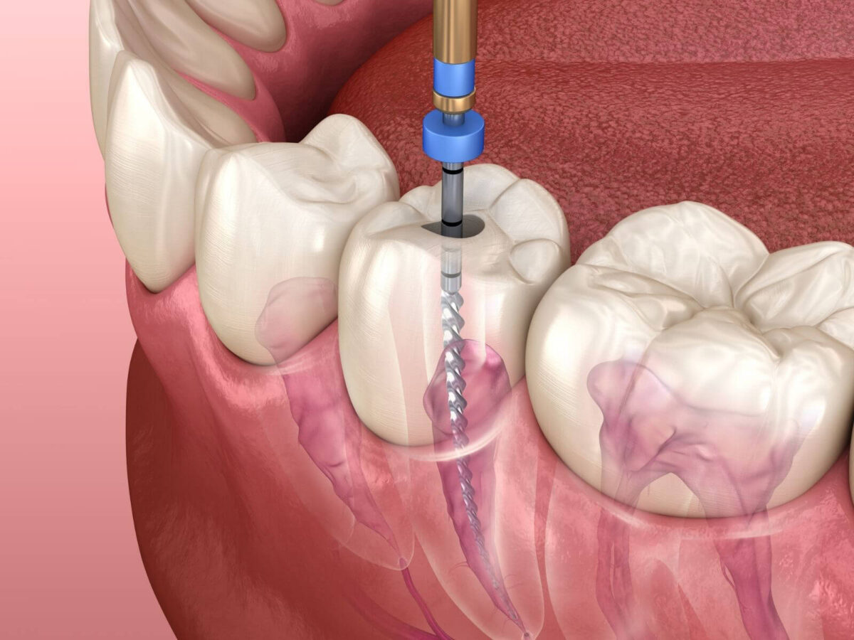 Can You Get A Root Canal With A Chipped Tooth?