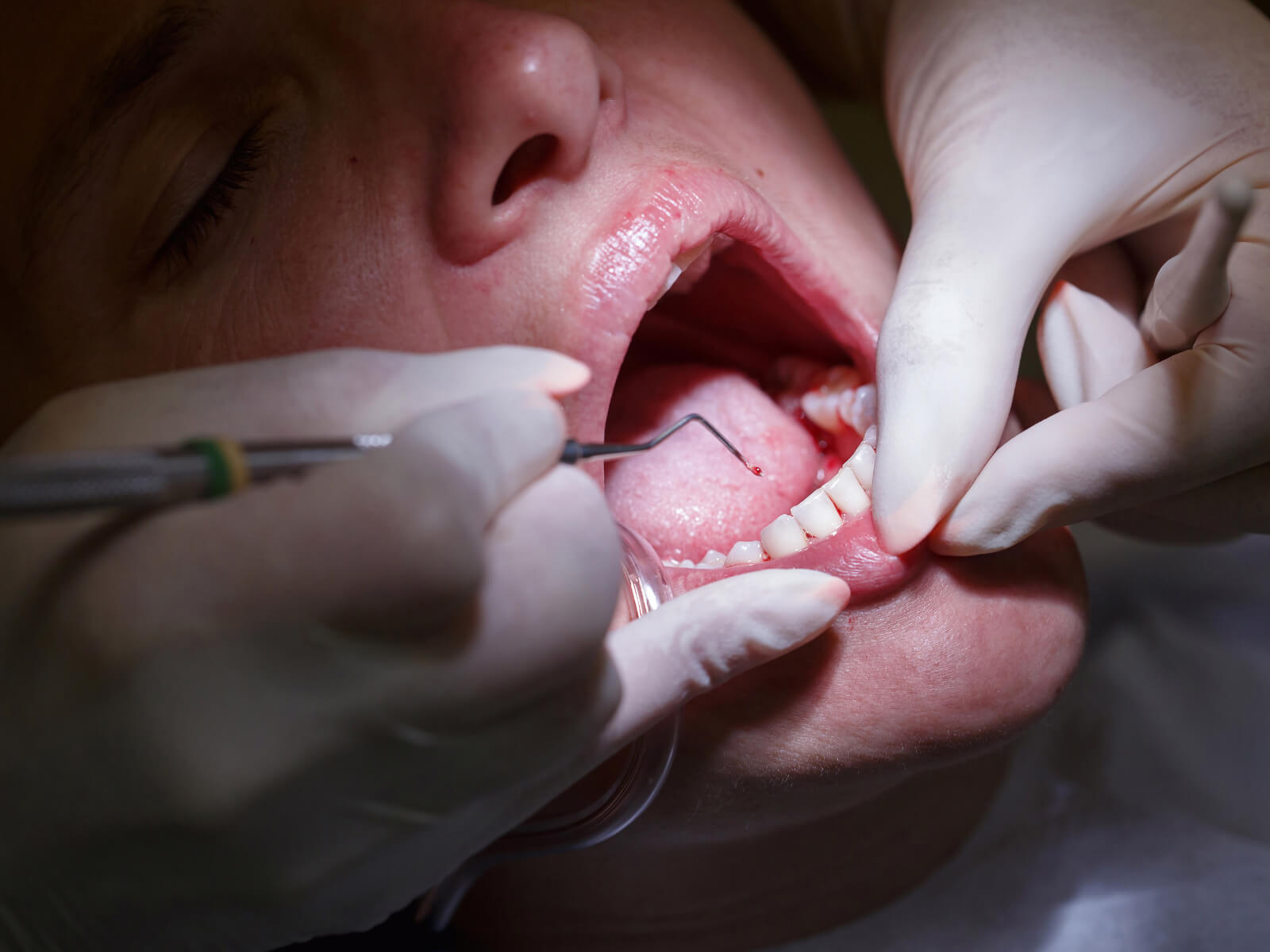 Periodontal Diseases And Malocclusion: Prevention And Treatment