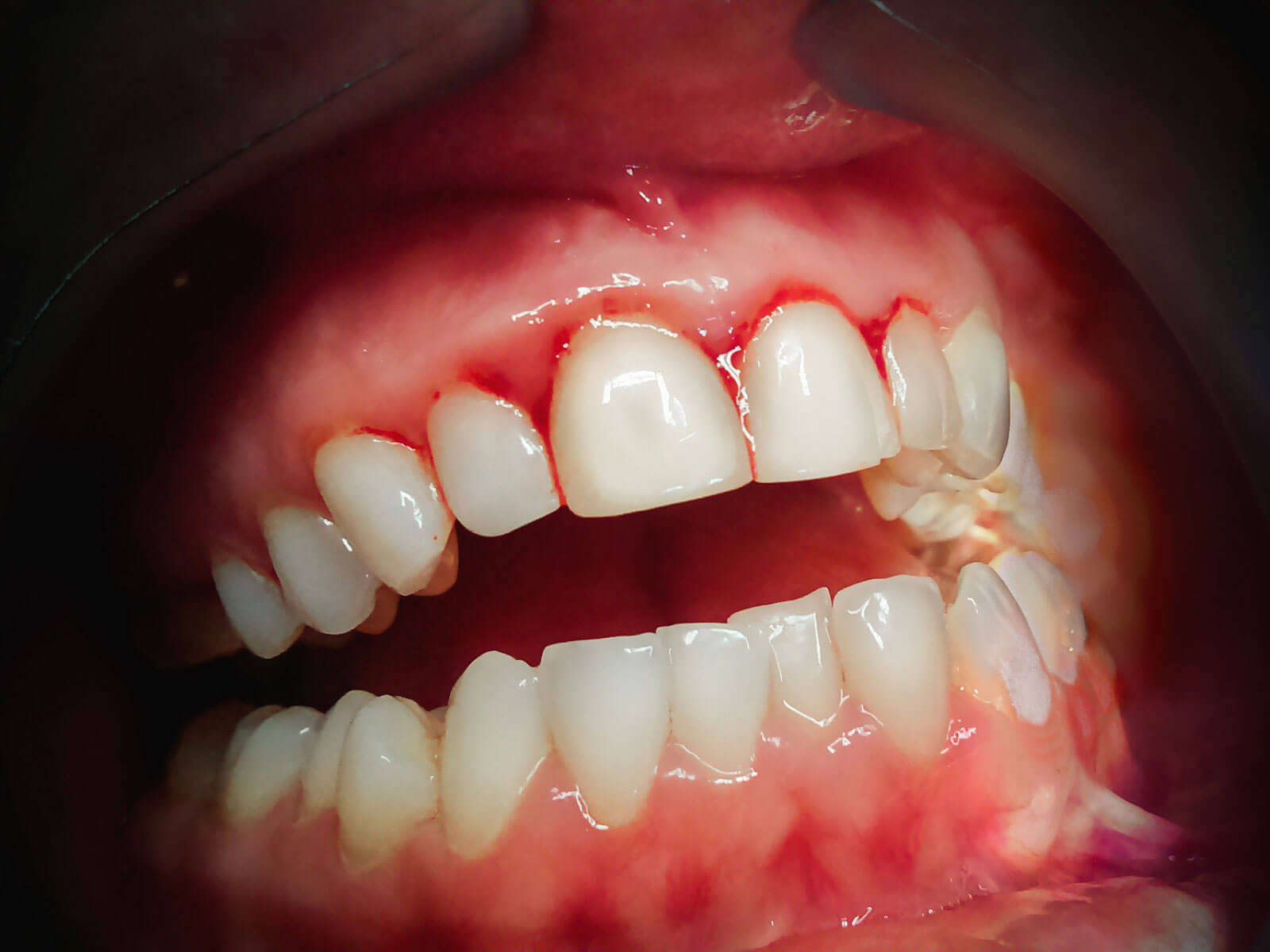 How to Stop Bleeding Gums Naturally and Medically