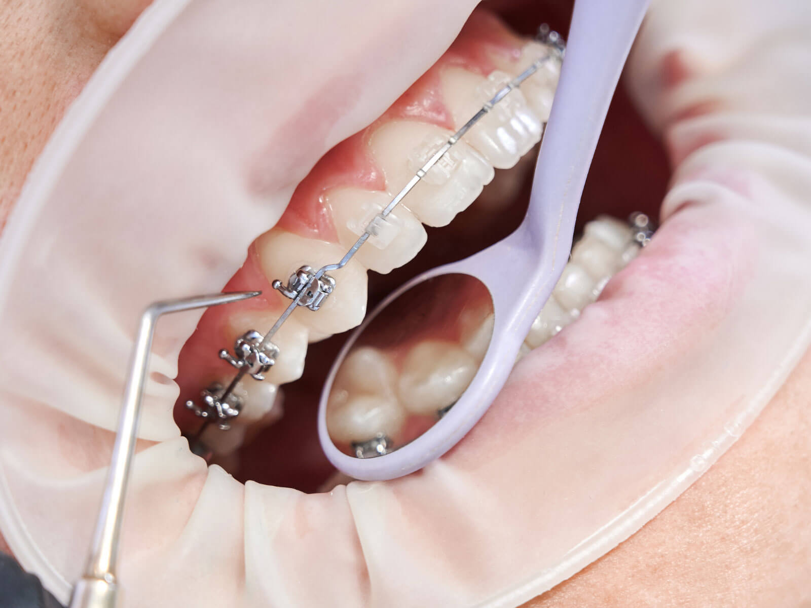 How Long Do You Have to Wear Braces? Treatment Timeline