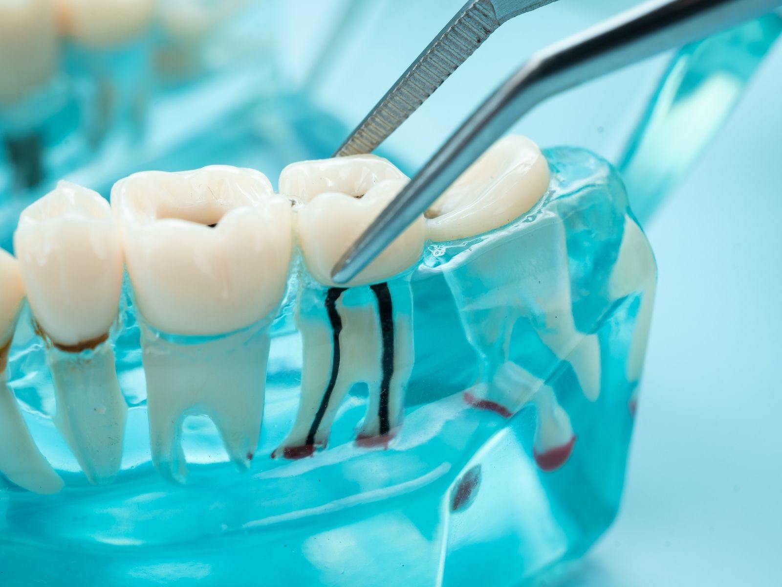 Do You Need an Emergency Root Canal? Signs and What to Expect
