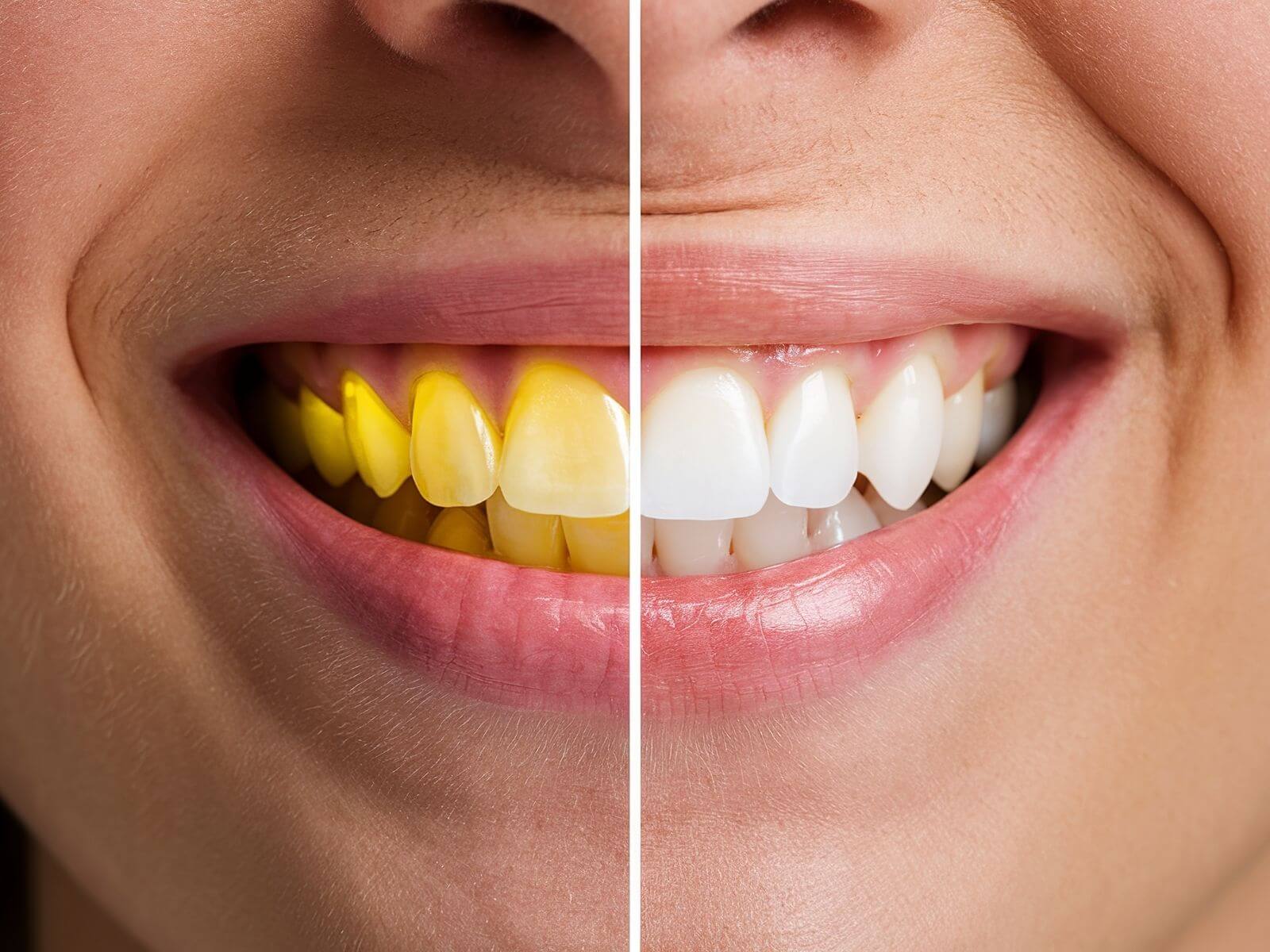 How to Get Rid of Yellow Teeth: 7 Home Remedies and Pro Treatments